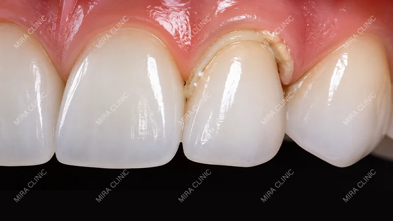 Dental cement residue near the gum